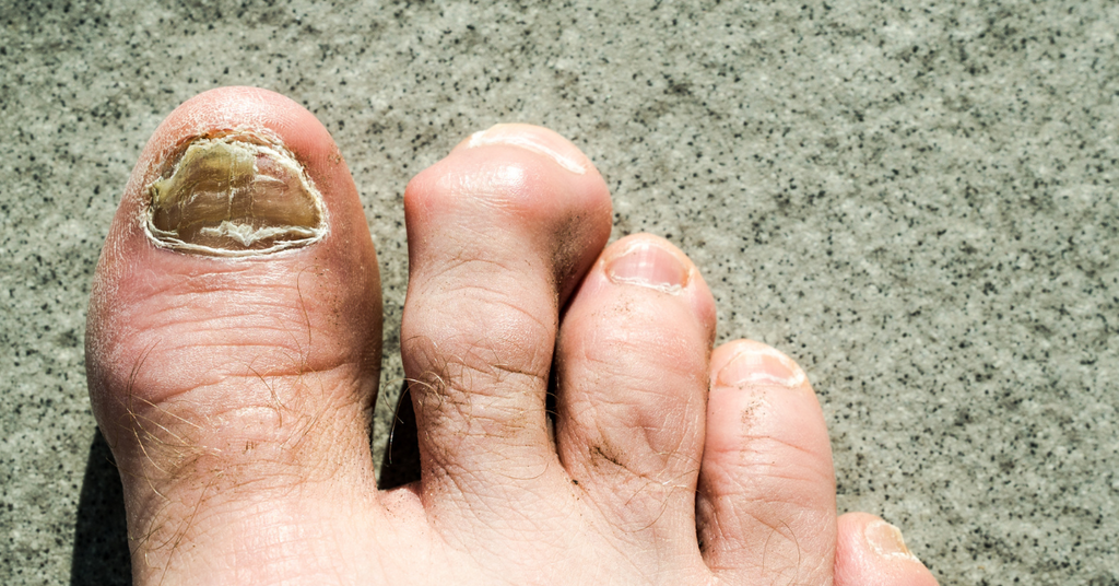 How to Get Rid of Nail Fungus on Toes