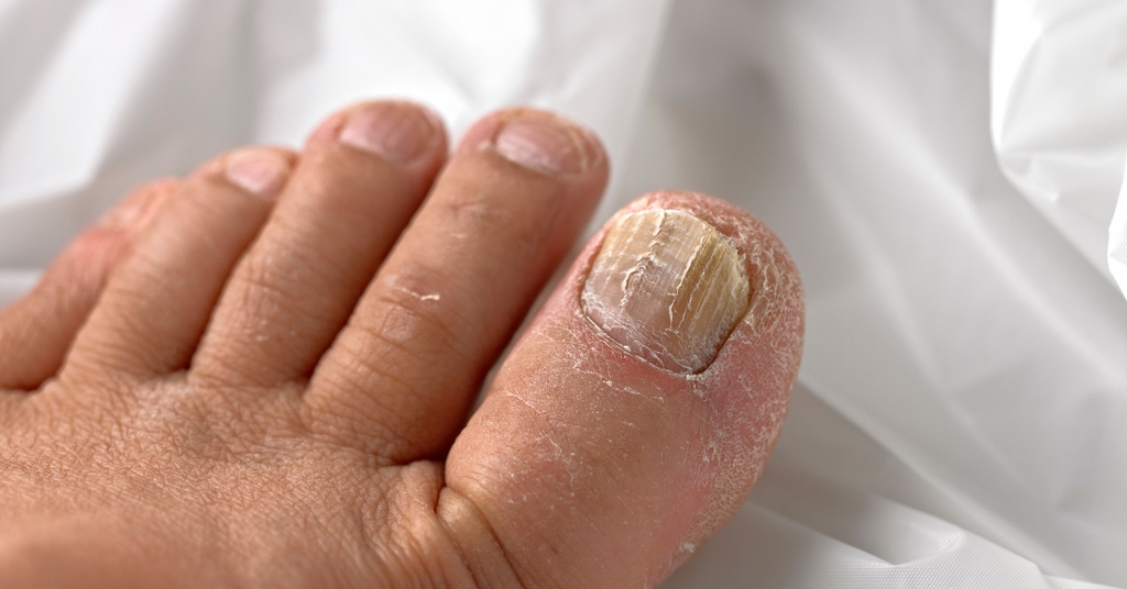 How to Fix Pincer Toenails at Home